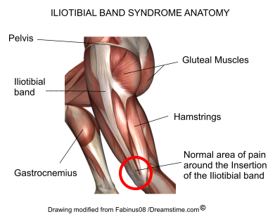 Common Running Injuries - Iliotibial Band Syndrome (ITBS) - 3 Dimensional  Physical Therapy